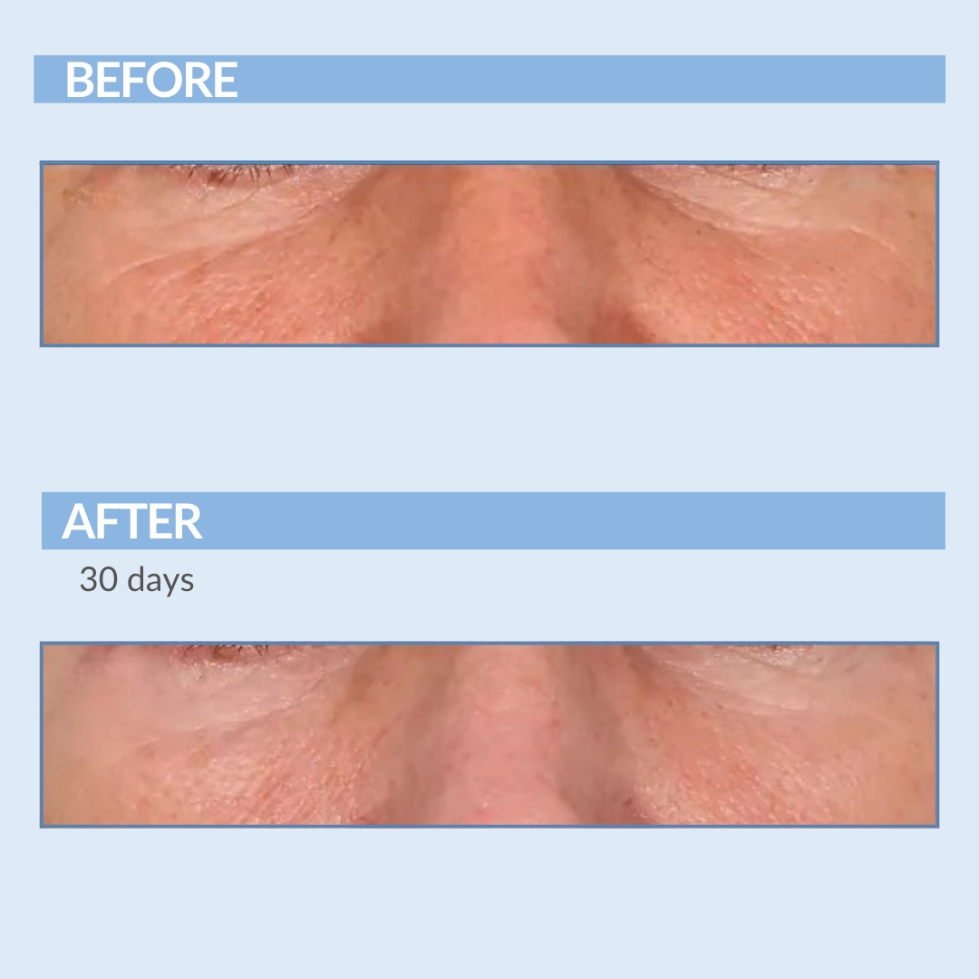 Before and After A-Eye