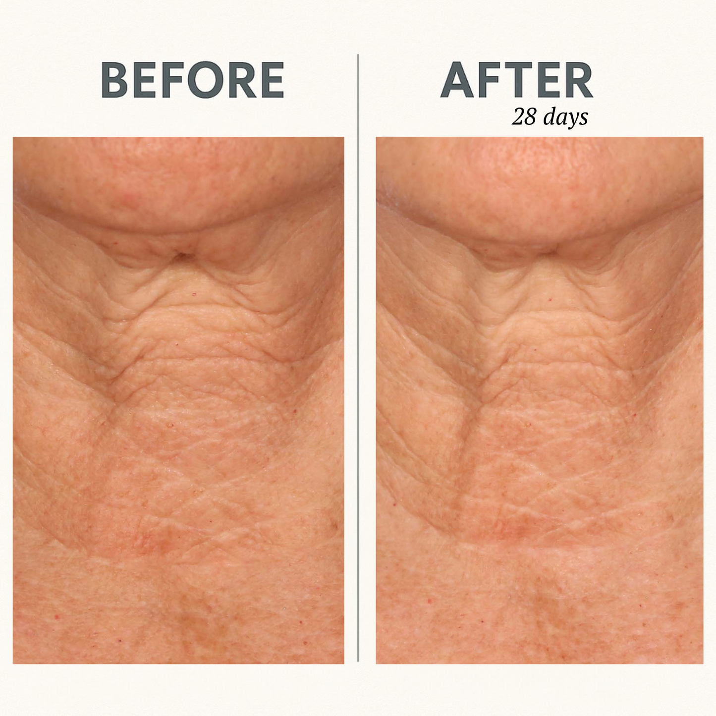 CORREC-CHIN™ IN-TENSE