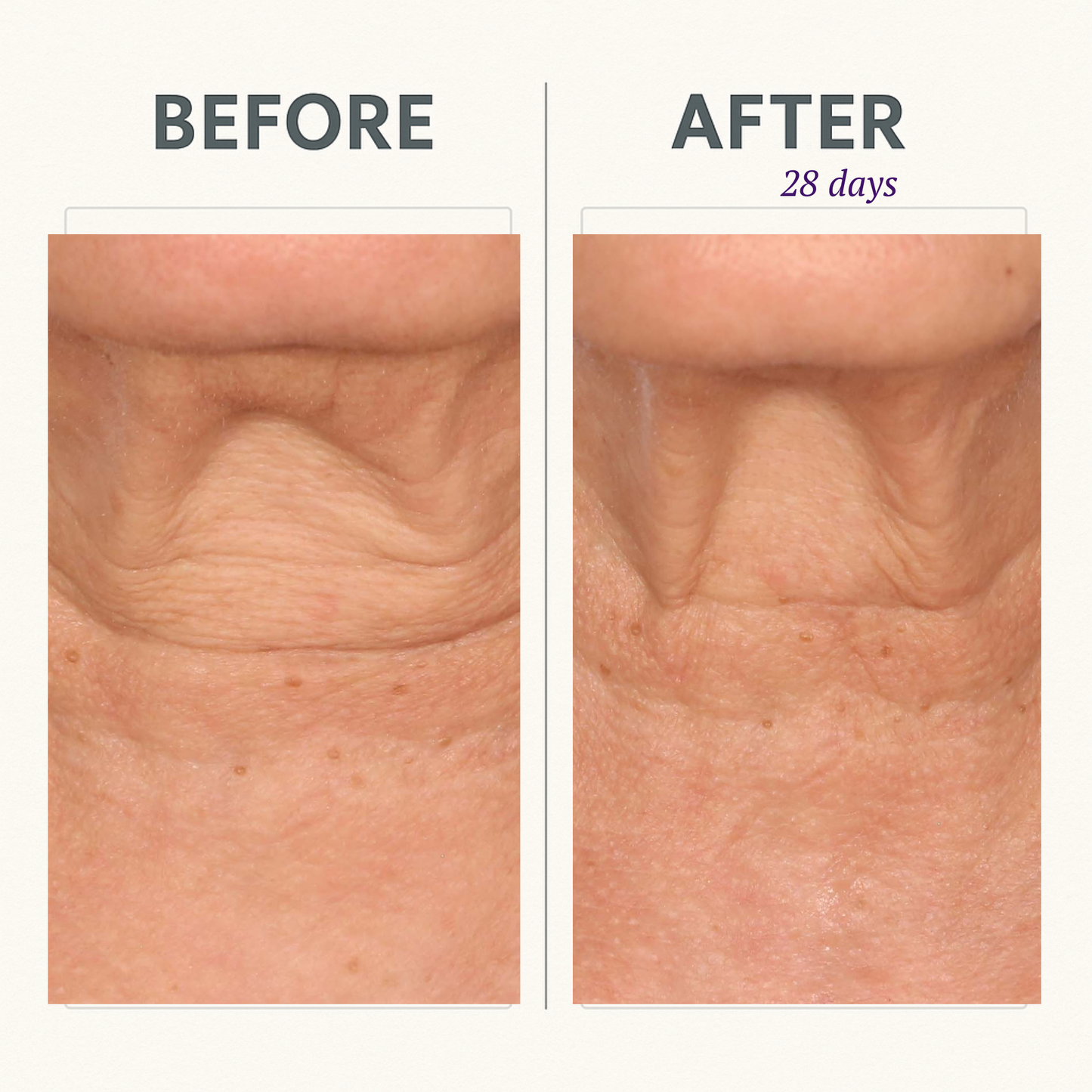 CORREC-CHIN™ IN-TENSE