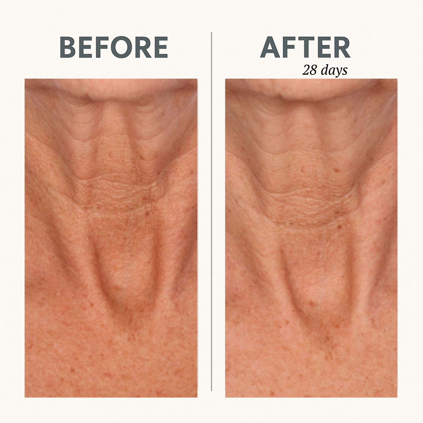 CORREC-CHIN™ IN-TENSE