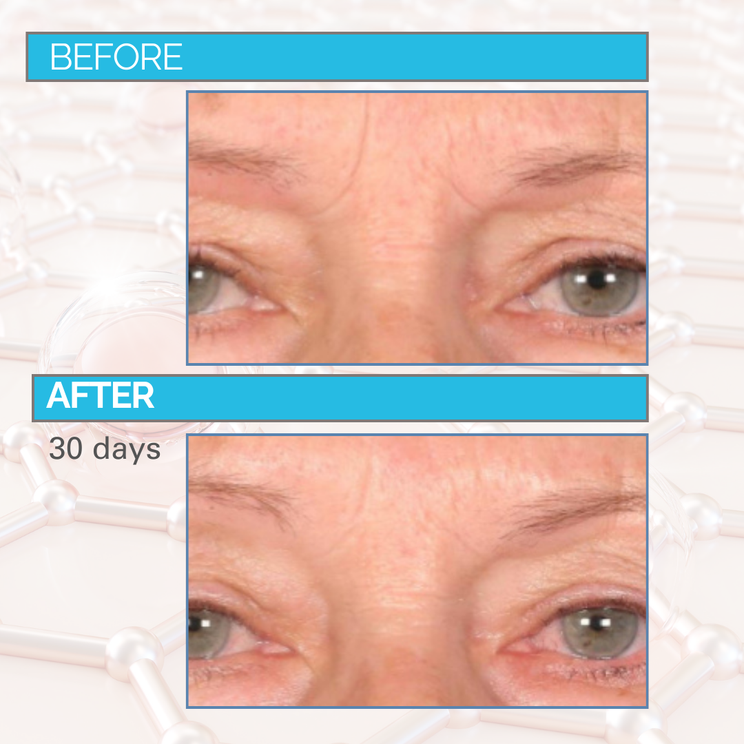 Trace + Erase Needle-Free Wrinkle Filler - TRY BEFORE YOU BUY
