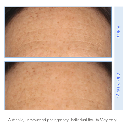 Before and after comparison of skin texture on a person's shoulder, labeled 'Before' and 'After 30 days'.