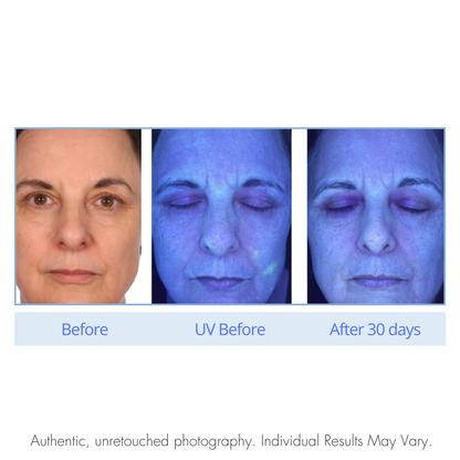 Before and after comparison of a person's face under UV light, showing changes over 30 days.