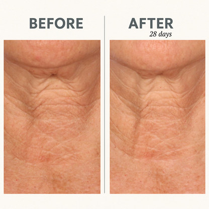 CORREC-CHIN™ IN-TENSE