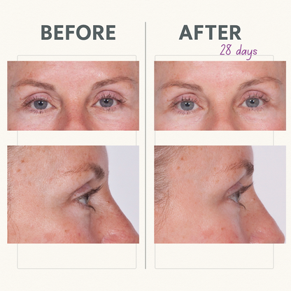 CORREC-CHIN™ INTENSE + Reverse Eye