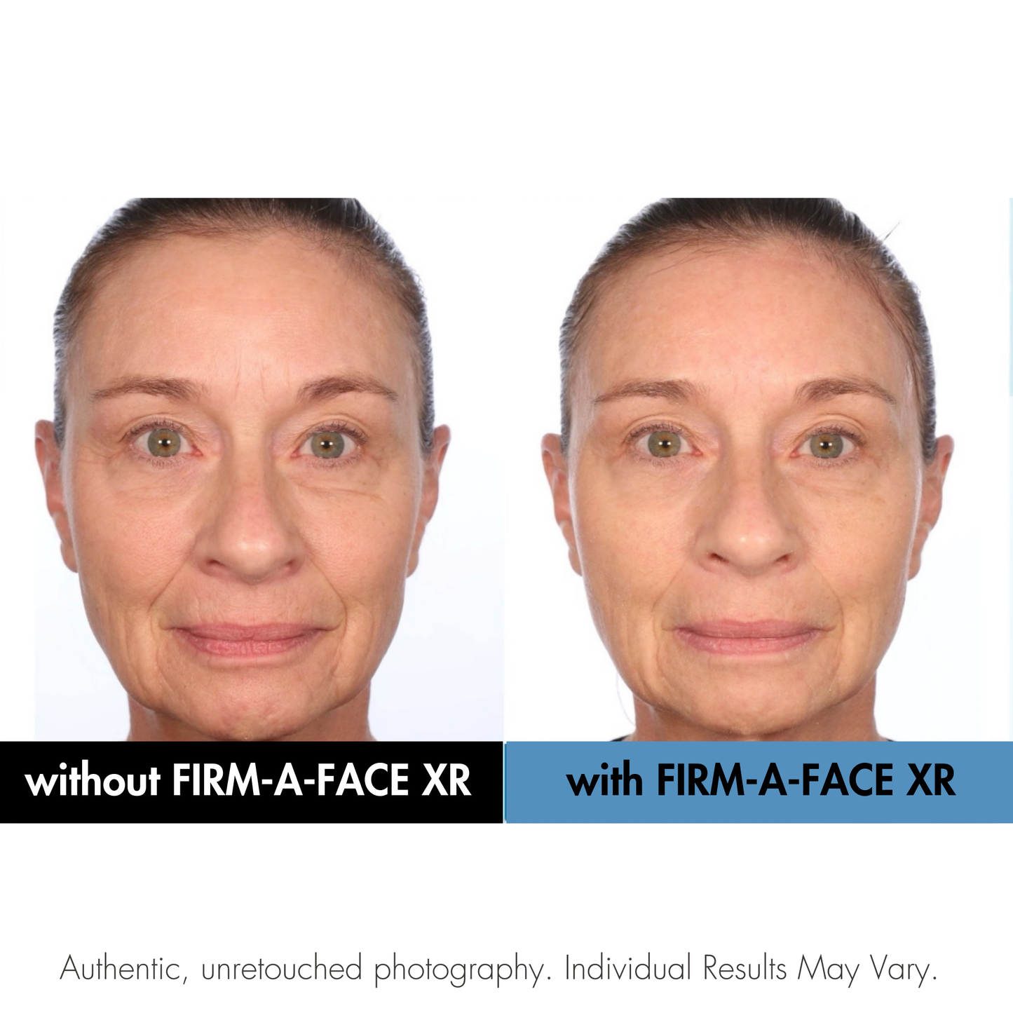 Before and after comparison of a woman's face with and without FIRM-A-FACE XR treatment.