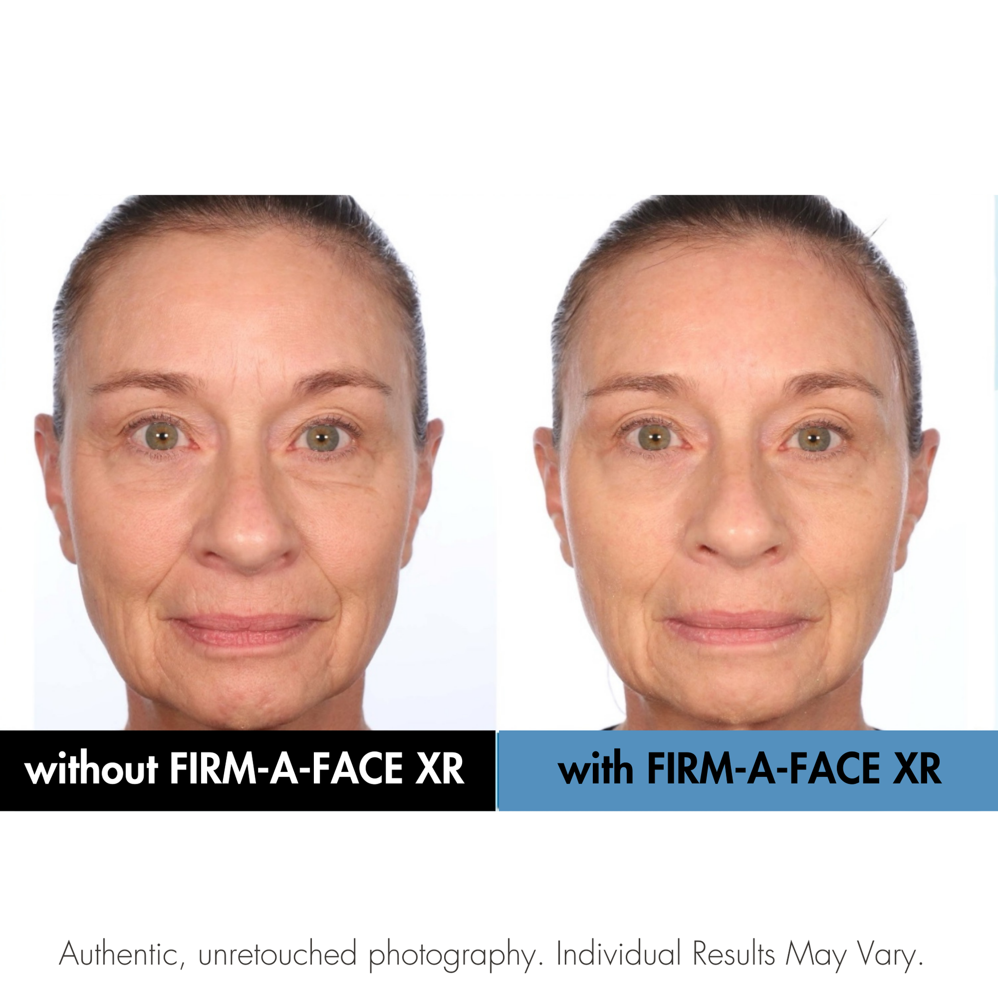 Before and after comparison of a woman's face with and without FIRM-A-FACE XR treatment.