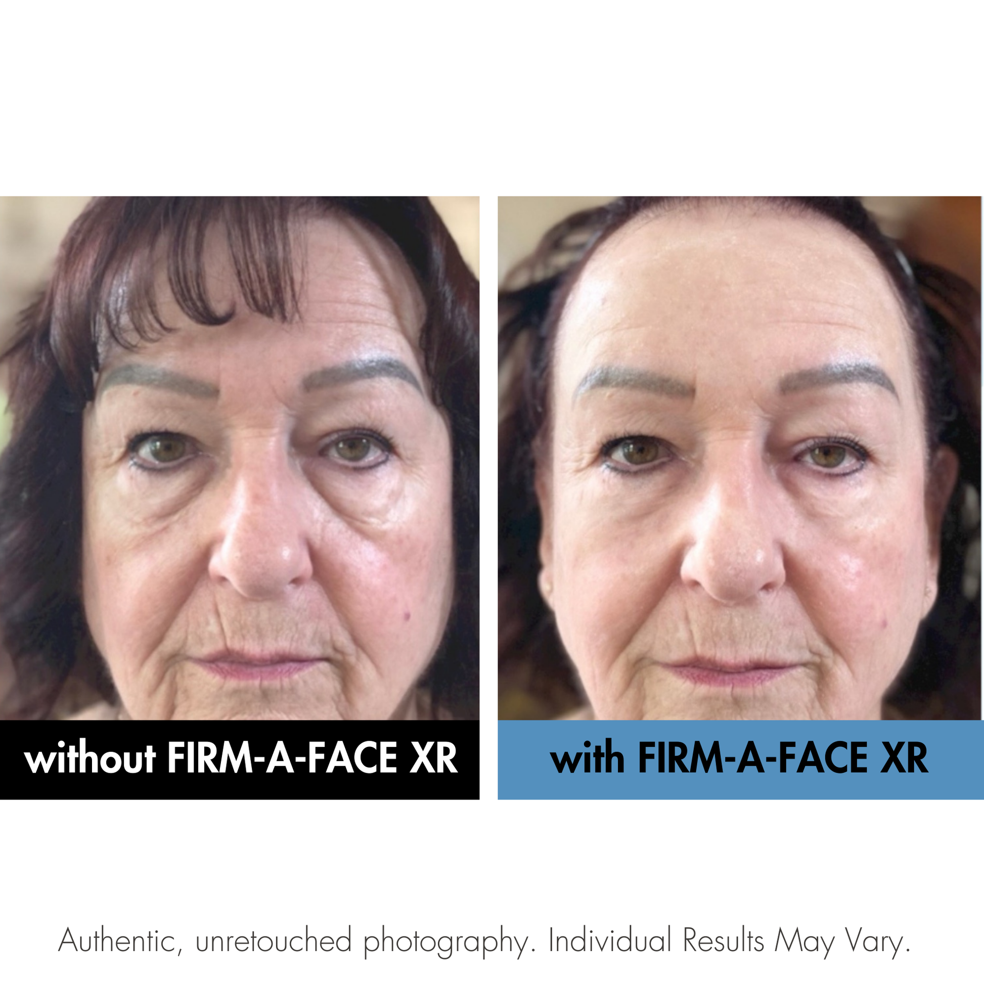 Before and after comparison of a woman's face with and without FIRM-A-FACE XR treatment.