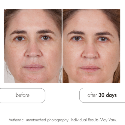 Before and after comparison of a woman's face with text indicating 'after 30 days'.  Glycolic Retexturizing by Serious Skincare