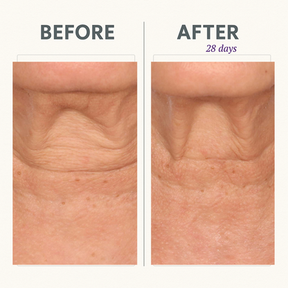 CORREC-CHIN™ IN-TENSE