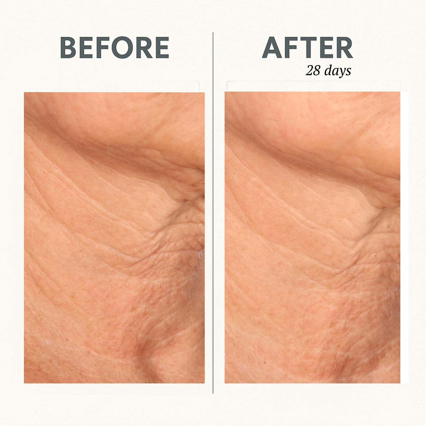 CORREC-CHIN™ IN-TENSE