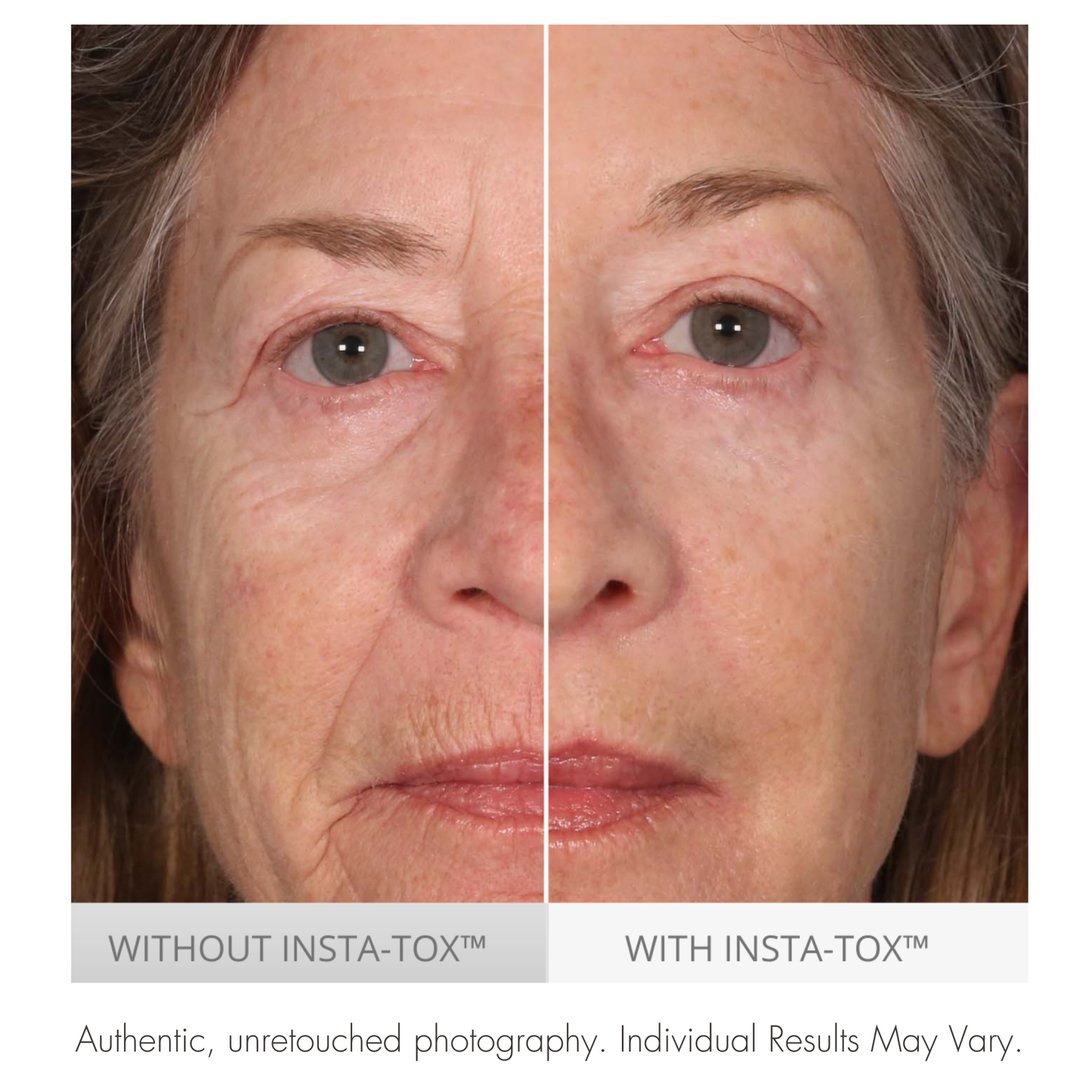 Before and after comparison of a woman's face with and without Insta-Tox treatment.