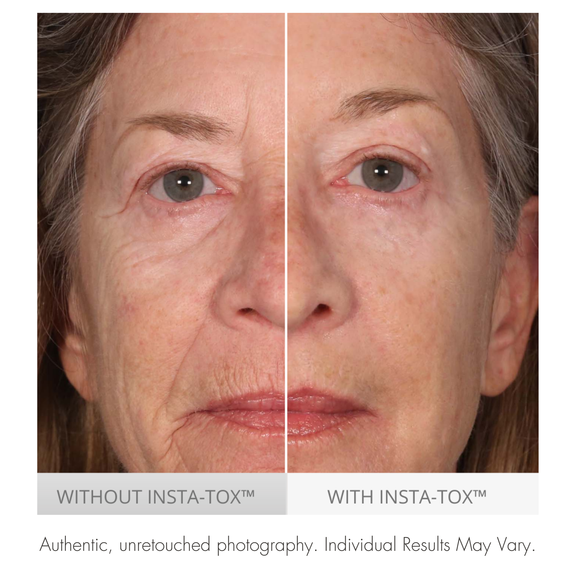 Before and after comparison of a woman's face with and without Insta-Tox treatment.