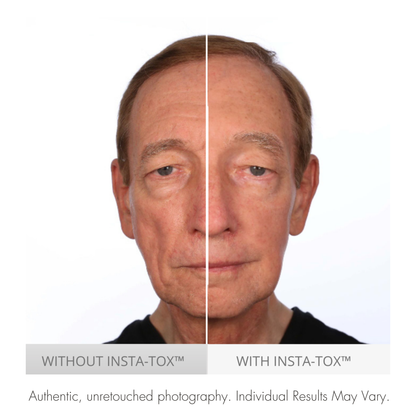 Before and after comparison of a man's face with and without Insta-Tox treatment.