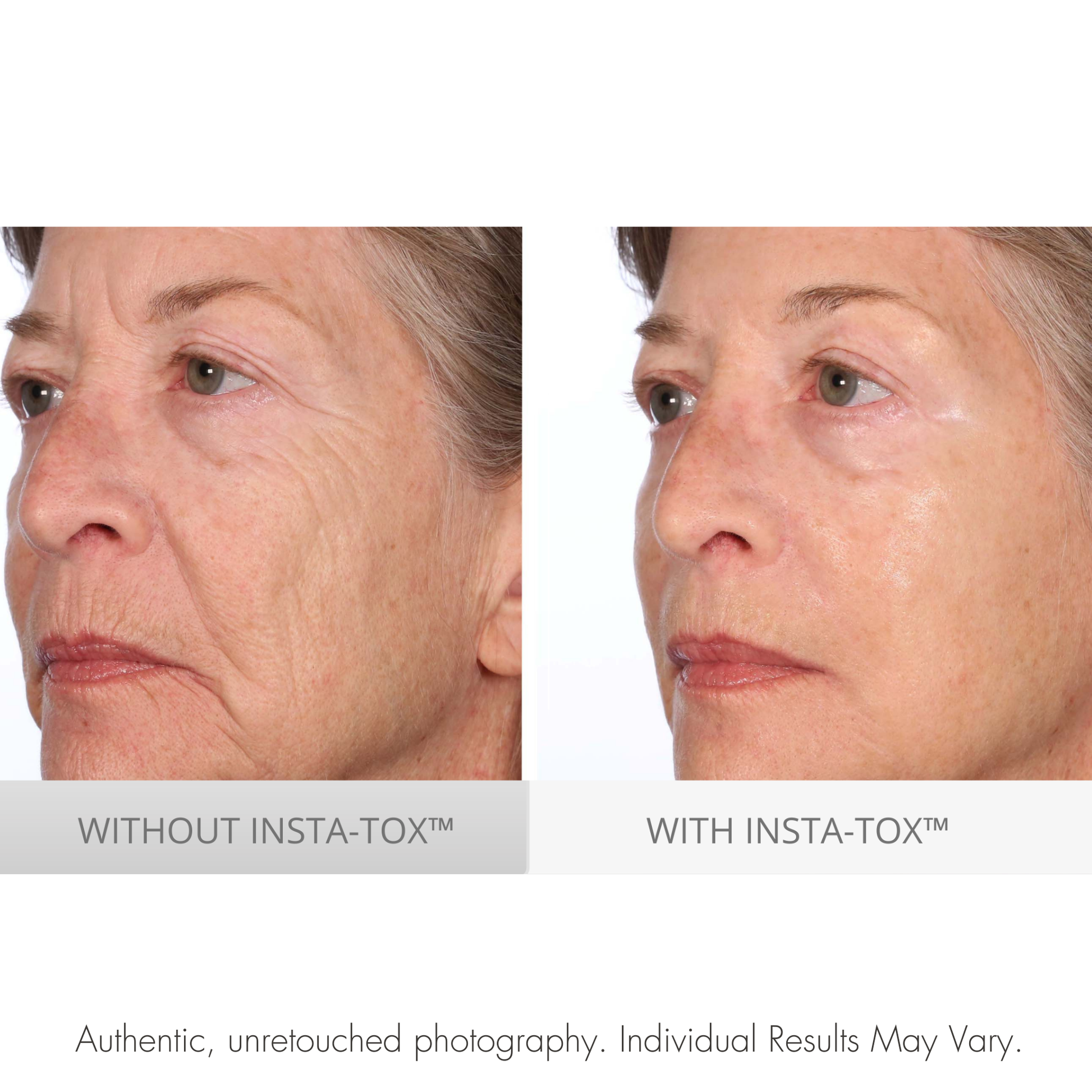 Before and after comparison of a woman's face with and without INSTA-TOX treatment.