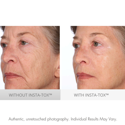 Before and after comparison of a woman's face with and without INSTA-TOX treatment.