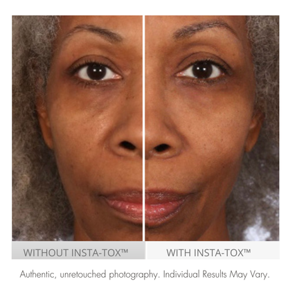 Before and after comparison of a woman's face with Insta-Tox treatment.