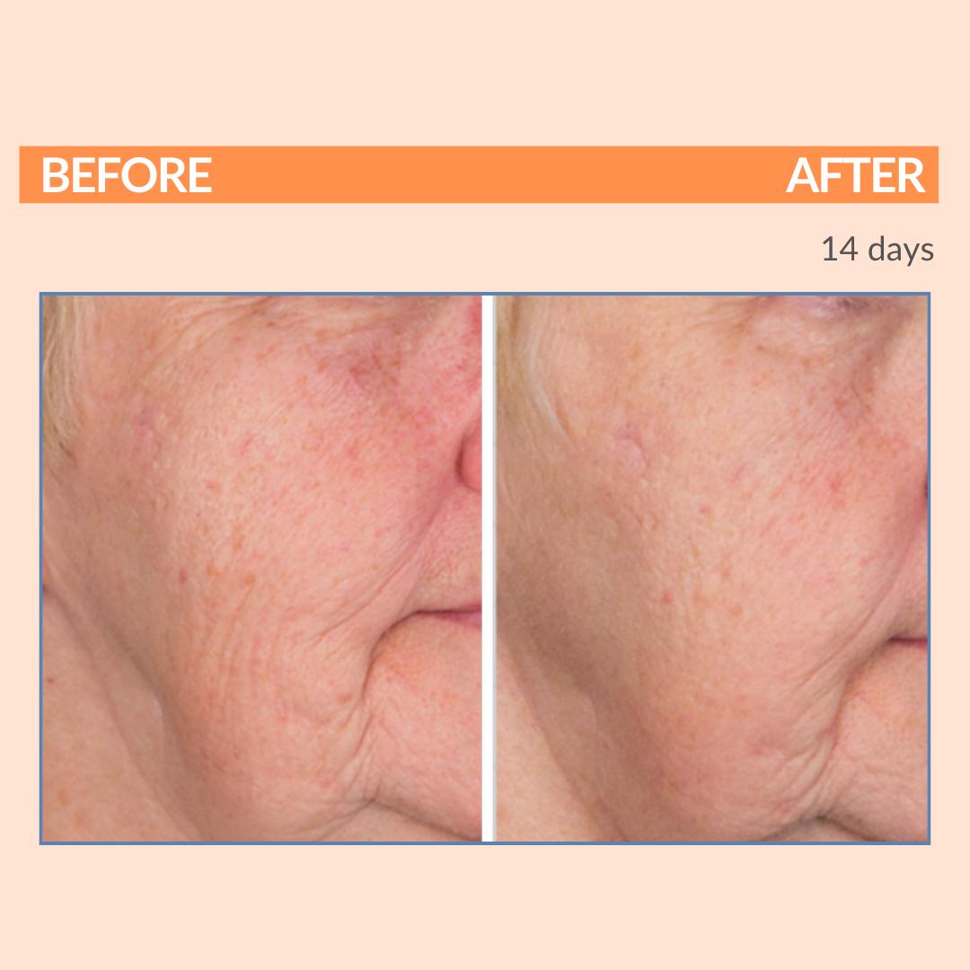 Serious C3 Before After Face