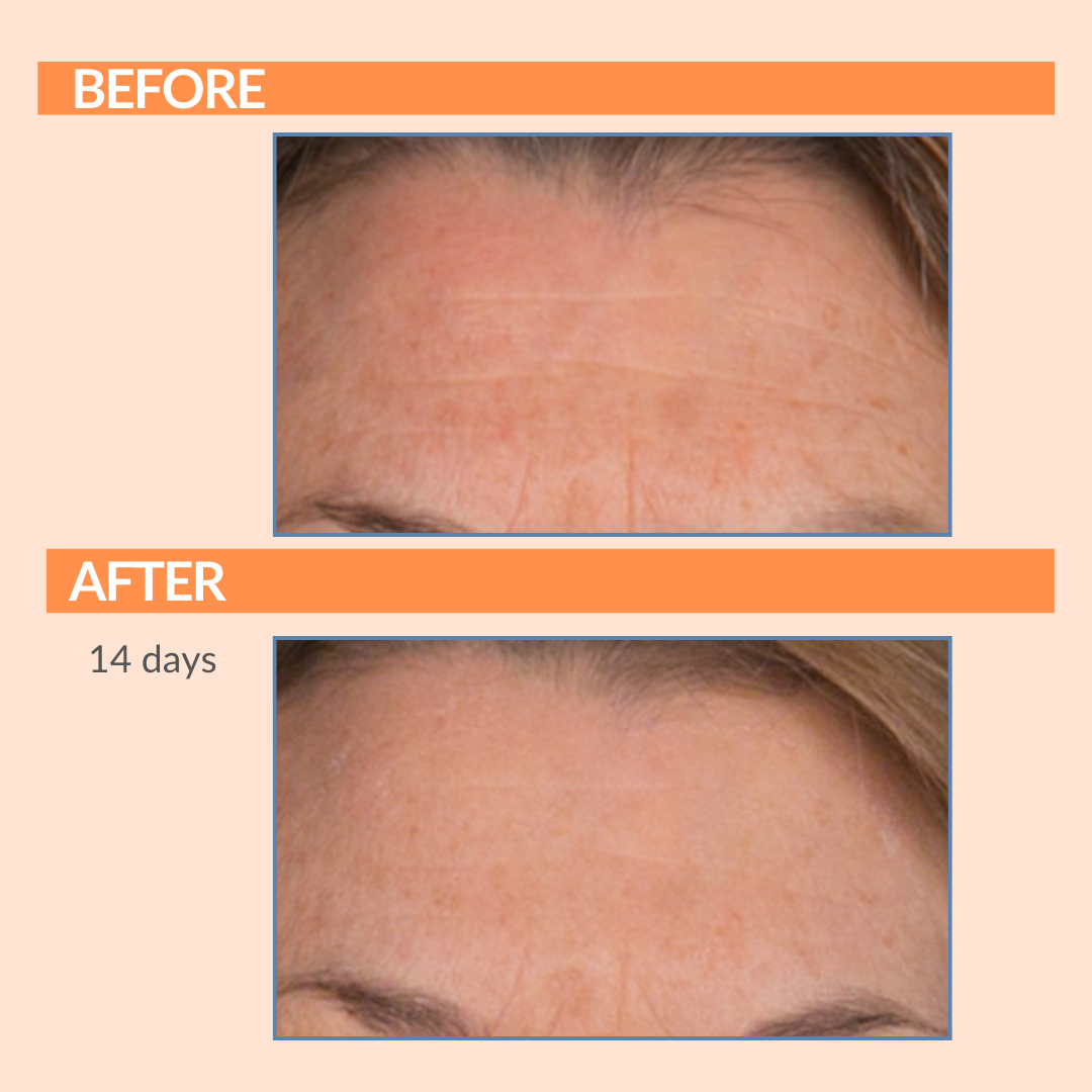 Serious C3 Before & After Forehead