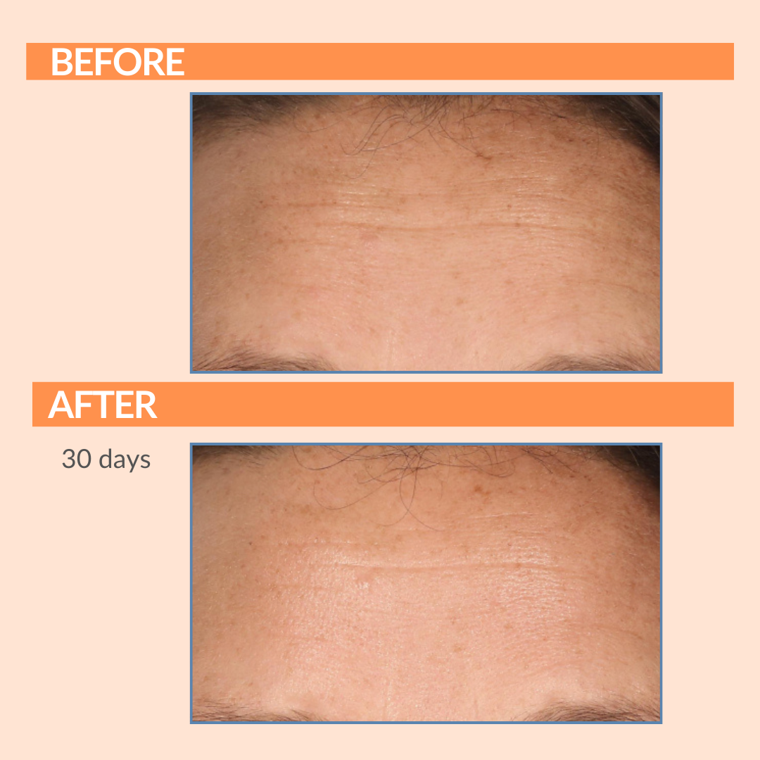 Serious C3 Before & After Forehead