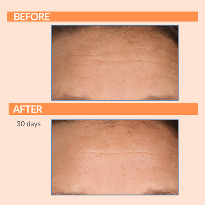 Serious C3 Before & After Forehead