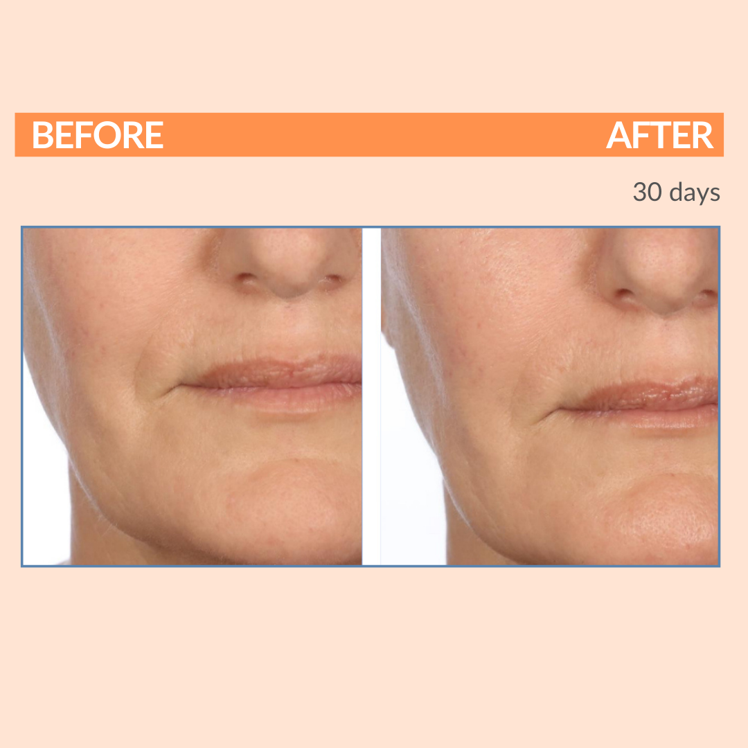 Serious C3 Before & After Right Face